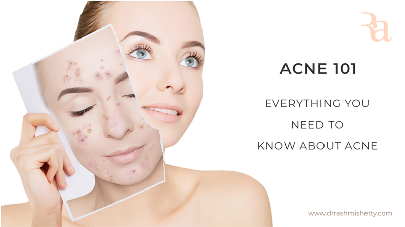 Acne 101: Everything You Need to Know About Acne - Dr. Rashmi Shetty