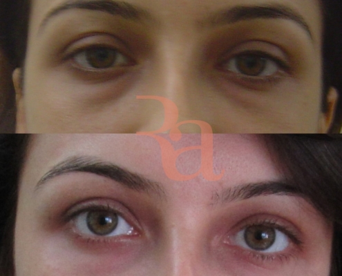 Before And After - Eyes