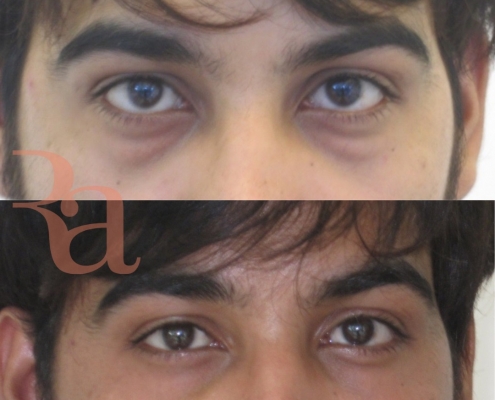 Before And After - Eyes